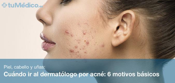 Cundo ir al dermatlogo por acn: 6 motivos bsicos