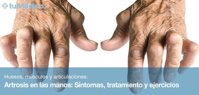 Artrosis en las manos: Sntomas, tratamiento y ejercicios